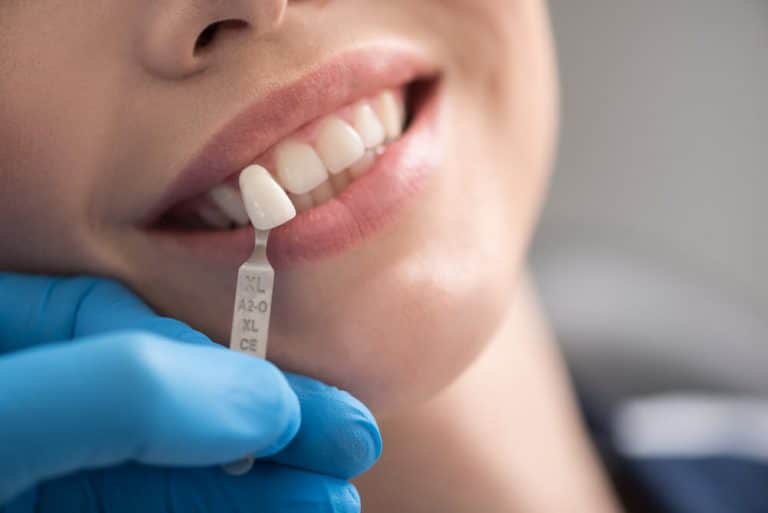 Veneers Dentist in Midland - Midland Dental Hub