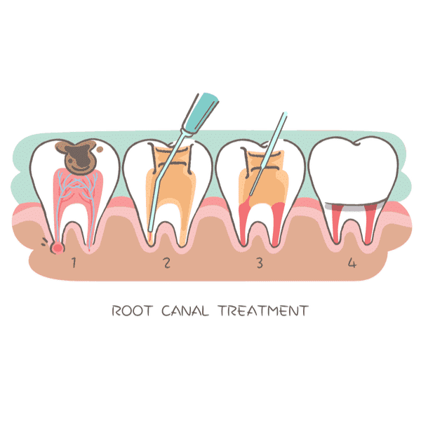 Root Canal Treatments – What to Expect