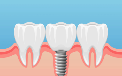Four Common Cosmetic Dentistry Procedures To Improve Your Smile
