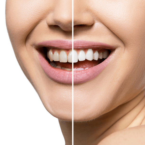 Is Teeth Whitening Safe?