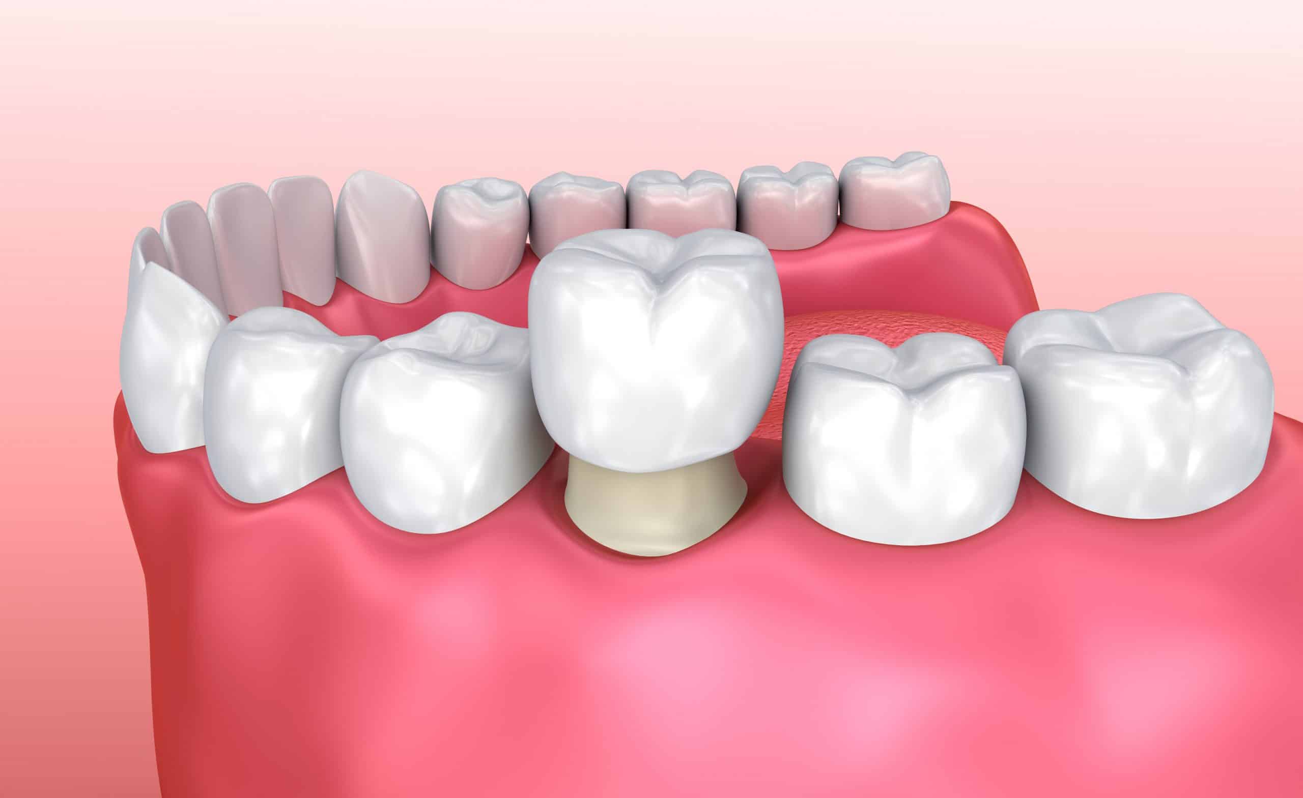 What is a Dental Crown? | Midland Dental Hub