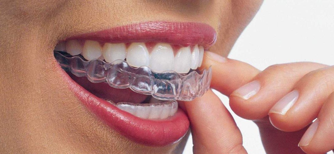 8 things to know before getting Invisalign