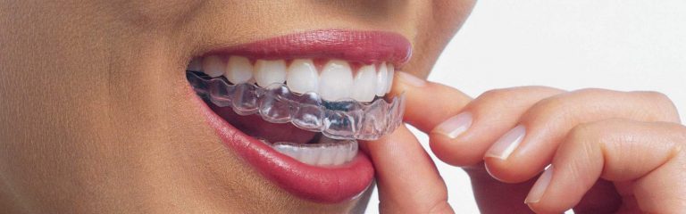 Invisalign Perth - Dentist in Midland - Dental Clinic Midland - Invisalign Perth Dentist in Midland - Dental Clinic Midland